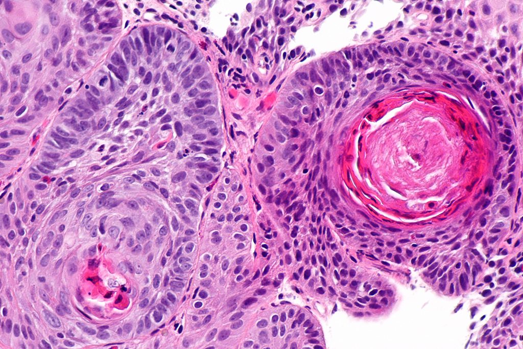 Carcinome oesophage