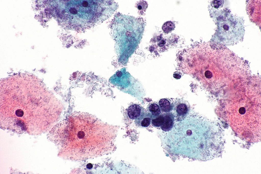 High-grade_squamous_intraepithelial_lesiong