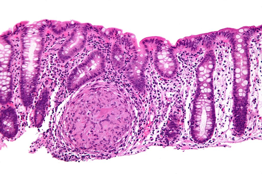 Maladie de Crohn