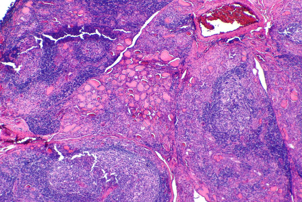 Thyroide Hashimoto
