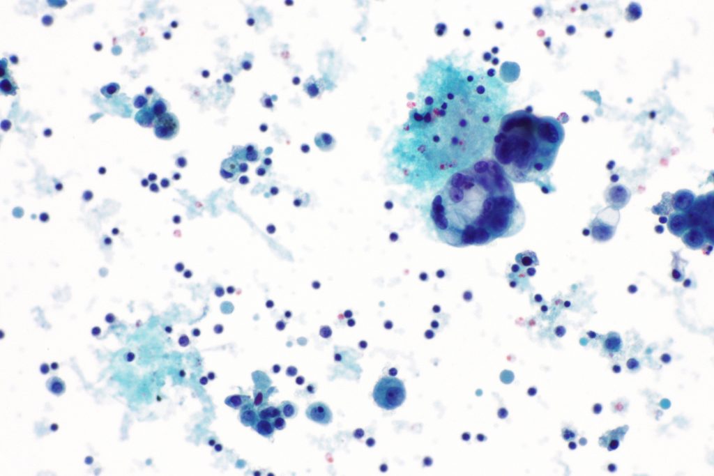 adénocarcinome poumon