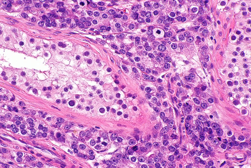 carcinome prostate